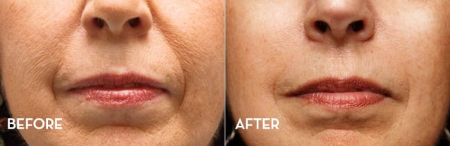 Smile Lines | Before and After | La Fontaine Aesthetics | Cherry Creek